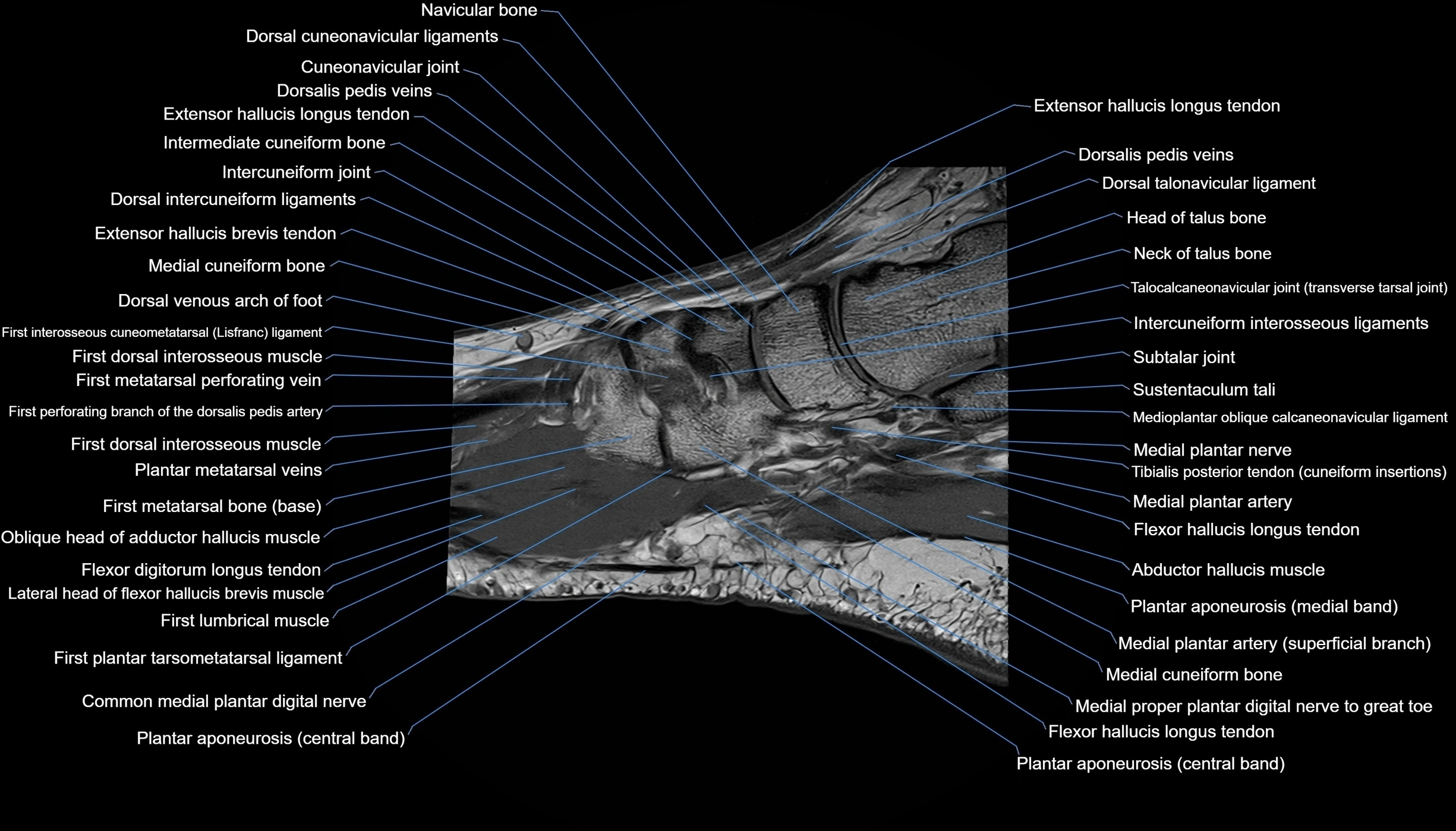 MRI mid foot sagittal cross sectional anatomy 3T  radiology  image-img-00001-00028.webp